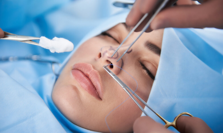 Cirurgia de rinoplastia: O que é, para quem é indicada, como é feita e ...
